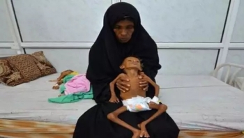 يونيسف: مليونا طفل يمني يعانون من سوء التغذية الحاد