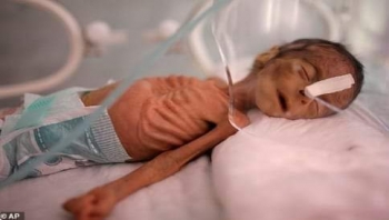 الصليب الأحمر: 90% من أطفال اليمن يعانون من سوء التغذية