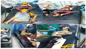 الضالع.. استشهاد 4 أطفال وإصابة 9 آخرين بانفجار مقذوف من مخلفات الحرب بقعطبة