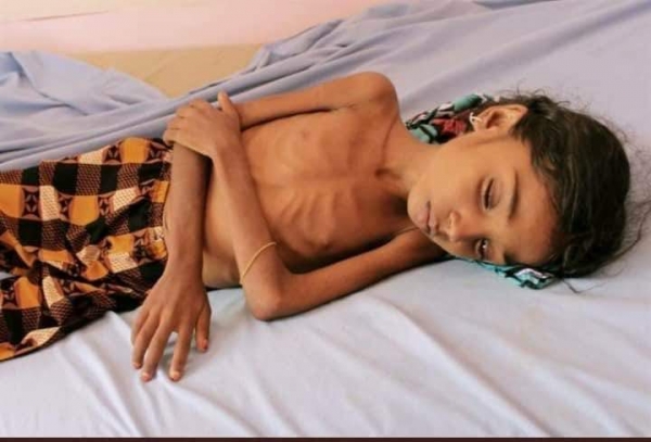 الأمم المتحدة: اليمن سيكون أفقر دولة في العالم لو استمرت الحرب عامين إضافيين