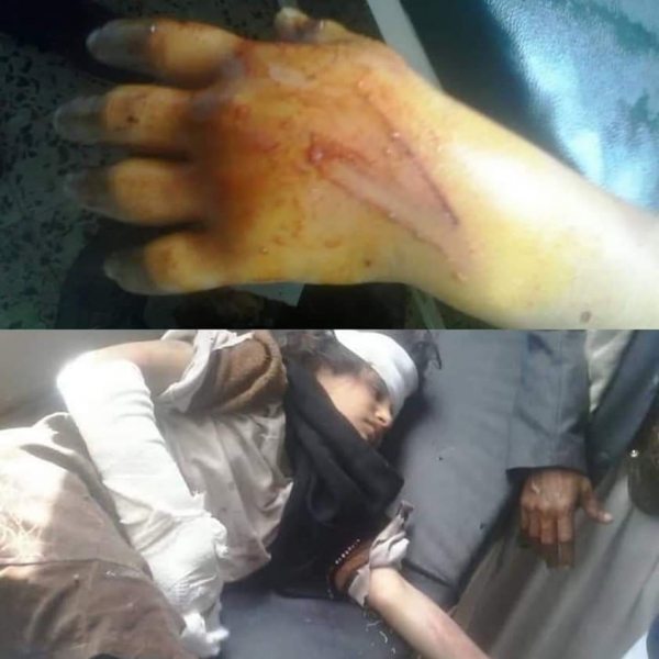 نجاة طفلة في إب من موت محقق بعد تعرضها لضرب مبرح