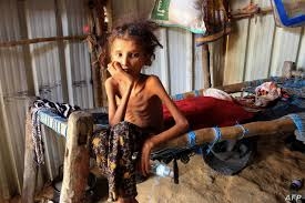 اليونيسف: تحذر من مخاطر الإصابة بسوء التغذية لملايين الأطفال اليمنيين قد يواجهون