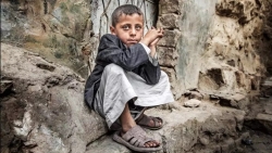 الضربات الجوية تشوه أطفال اليمن وتترك ندوبا في أجسادهم