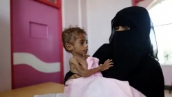 الأمم المتحدة: نصف أطفال اليمن يعانون سوء التغذية المزمن